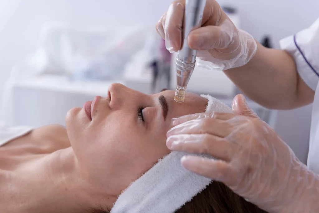 Microneedling Treatment in San Ramon, CA | Medspa Ca