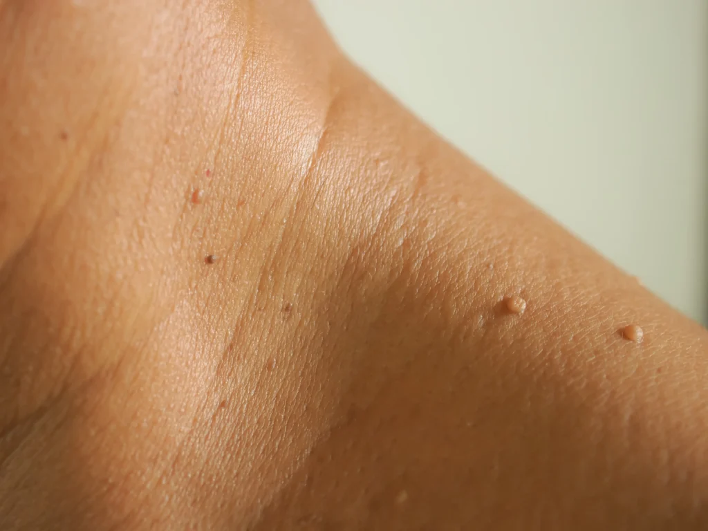 Skin Tag Removal in San Ramon, CA | Medspa Ca