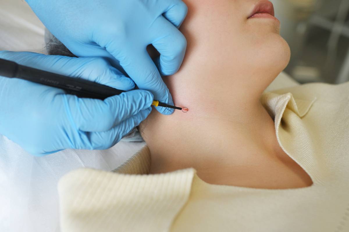 Mole Removal _ MedSpa California _ San Ramon, CA