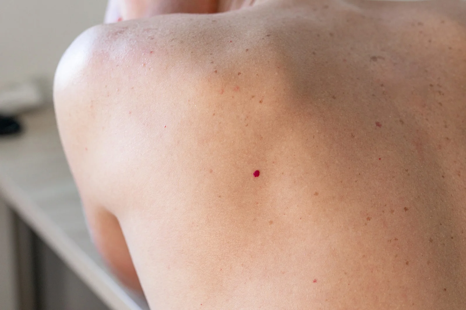 Cherry Angioma Removal in San Ramon, CA | Medspa California